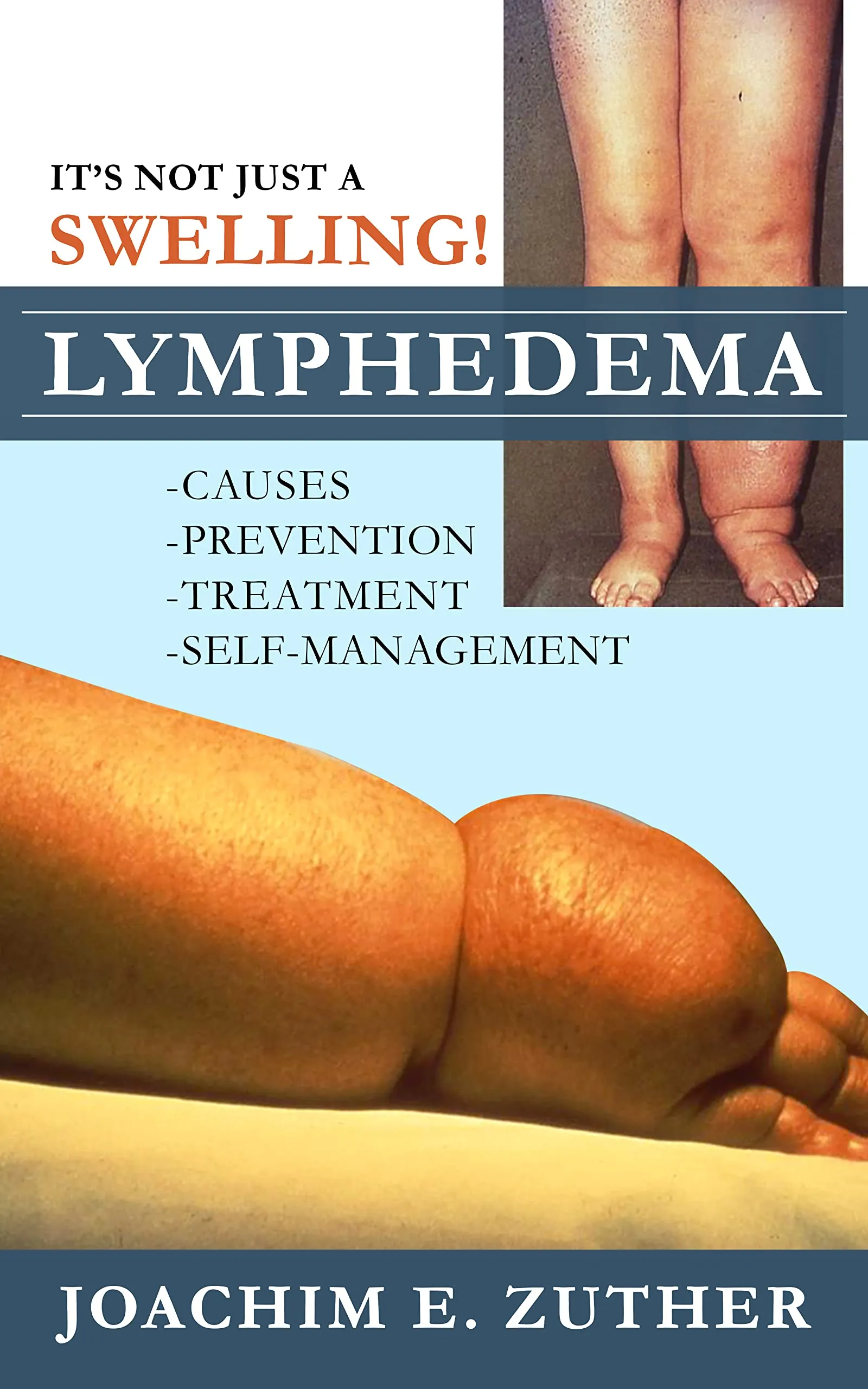 Lymphedema Guide: Causes, Prevention, Treatment, and Self-Management - Expert Insights